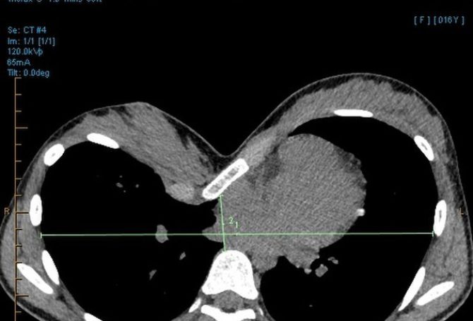 Image for Pectus Excavatum: Old Problem, Brief History, New Evidence